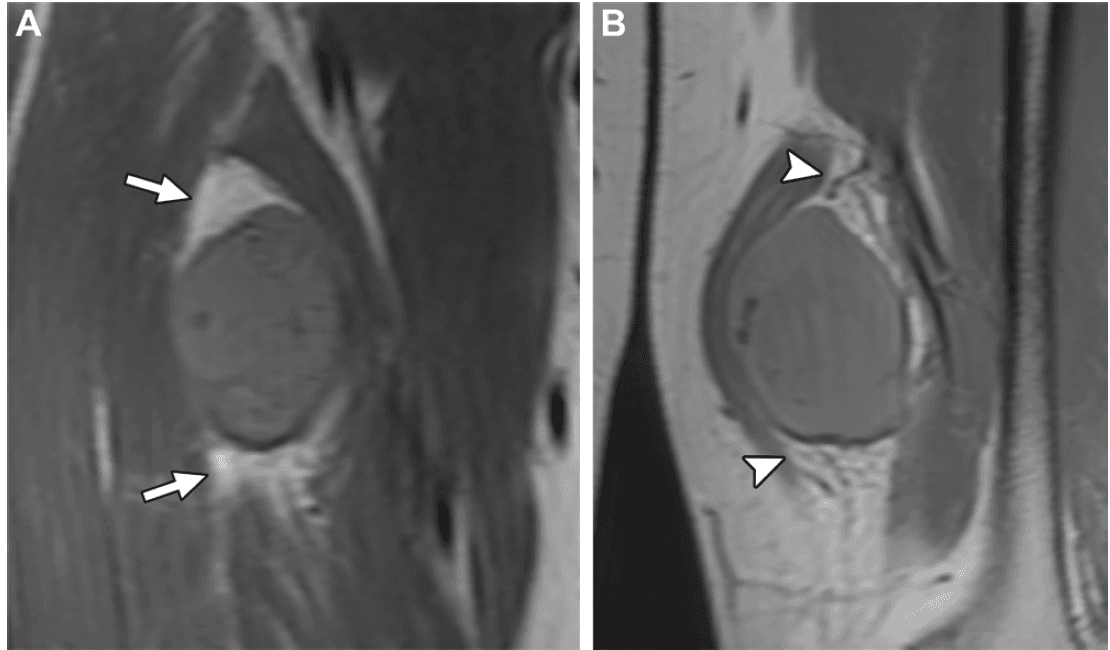 Split fat sign indicating an intermuscular tumor location in two patients. (A) Coronal T1-weighted MR image in a 39-yearold woman with schwannoma shows the split fat sign (arrows). (B) Coronal T1-weighted MR image in a 31-year-old man with synovial sarcoma also shows the split fat sign (arrowheads).