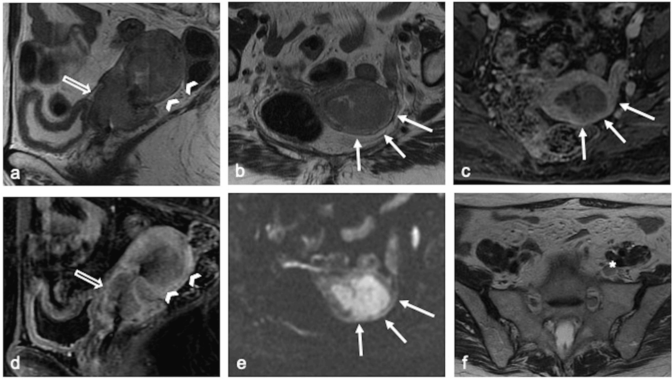 Typical endometrial cancer MRI findings in a 65-year-old woman presenting with a uterine mass. The cervical biopsy was consistent with adenocarcinoma of endometrial origin. (a) Sagittal FSE T2-WI shows endometrial thickening with a soft-tissue mass expanding the endometrial cavity (arrowheads) with elongated shape and longitudinal growth. The tumor extends below the internal uterine os and invades the cervical stroma (empty arrow). (b) Axial oblique FSE T2-WI and (c) postgadolinium axial T1-WI fat sat of the uterine body show the deep myometrial invasion in the left lateral and posterior uterine wall (white arrows). Endometrial tumor is hypovascular compared with the adjacent myometrium. (d) Post-gadolinium sagittal T1-WI fat sat shows low-SI lesion involving the uterine body (arrowheads) and the cervical stroma (empty arrow). (d) DWI shows diffusion restriction of the tumor and confirms deep myometrial invasion. In the (f) axial FSE T2-WI of the pelvis a left common iliac lymph node can be noted (asterisk). The patient underwent a hysterectomy with confirmation of the endometrial origin of the tumor. WI: weighted images; SI: signal intensity.